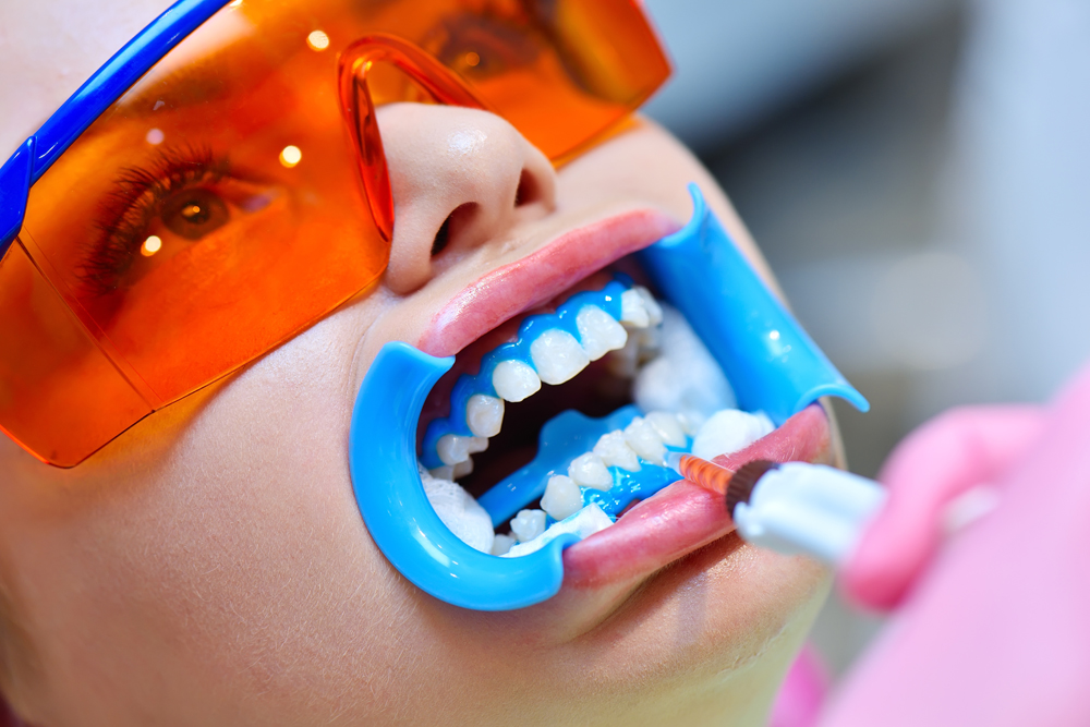 Dentist applies gel to teeth before teeth whitening procedure. Beautiful girl in safety glasses. Dental And Teeth Whitening Concept, Stichwort Zahnarzt.
(c) AdobeStock